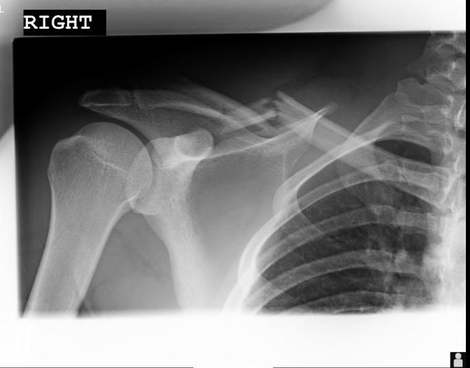 http://i168.photobucket.com/albums/u162/hockey819/collarbone1.jpg