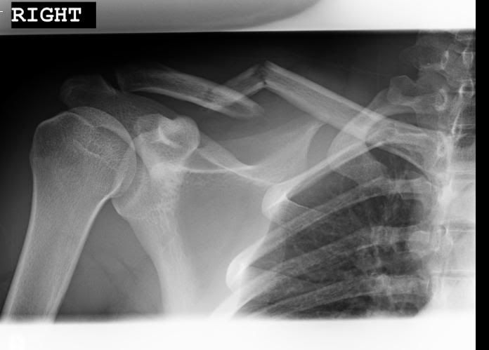 http://i168.photobucket.com/albums/u162/hockey819/collarbone2.jpg