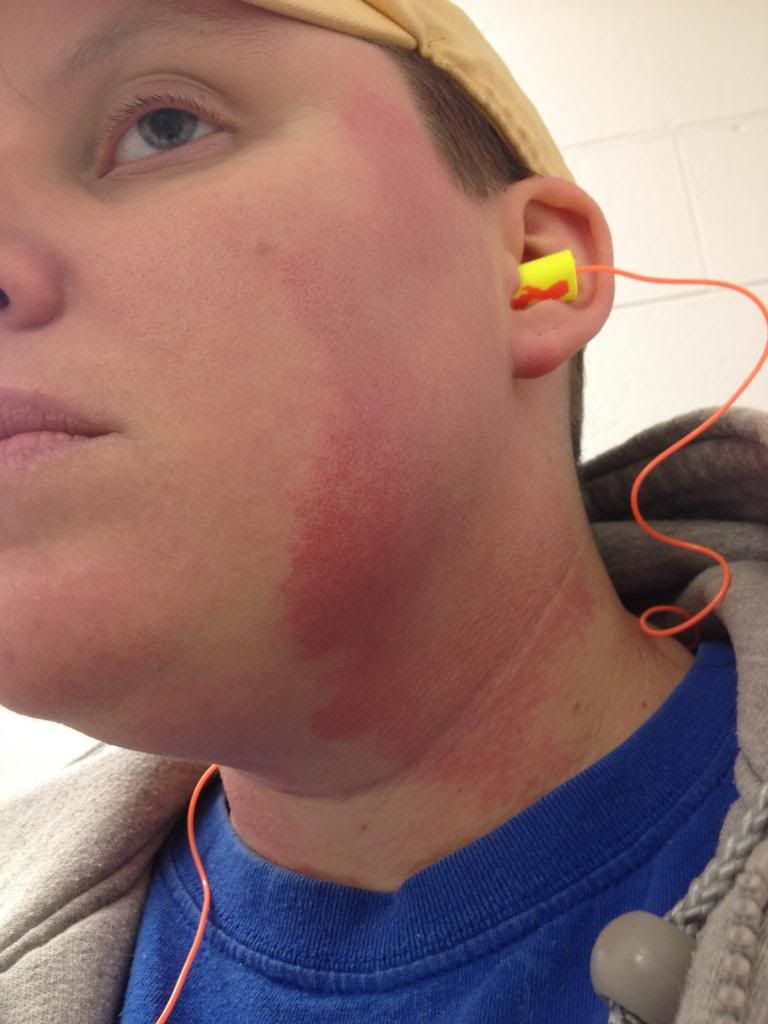 Severe flushing with sharp margins