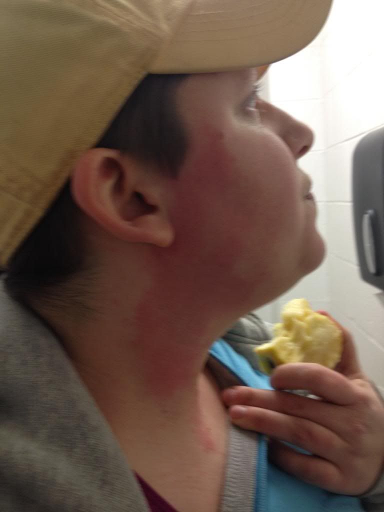 Severe flushing with sharp margins